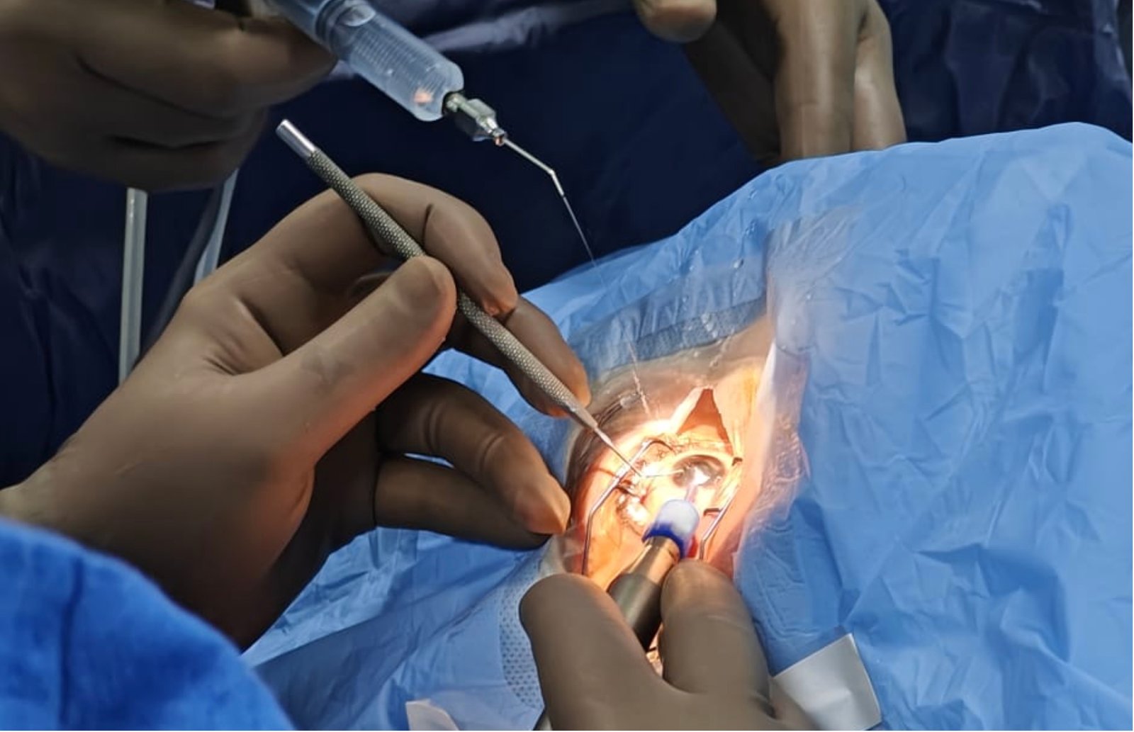 Types of Cataract Surgery in Delhi