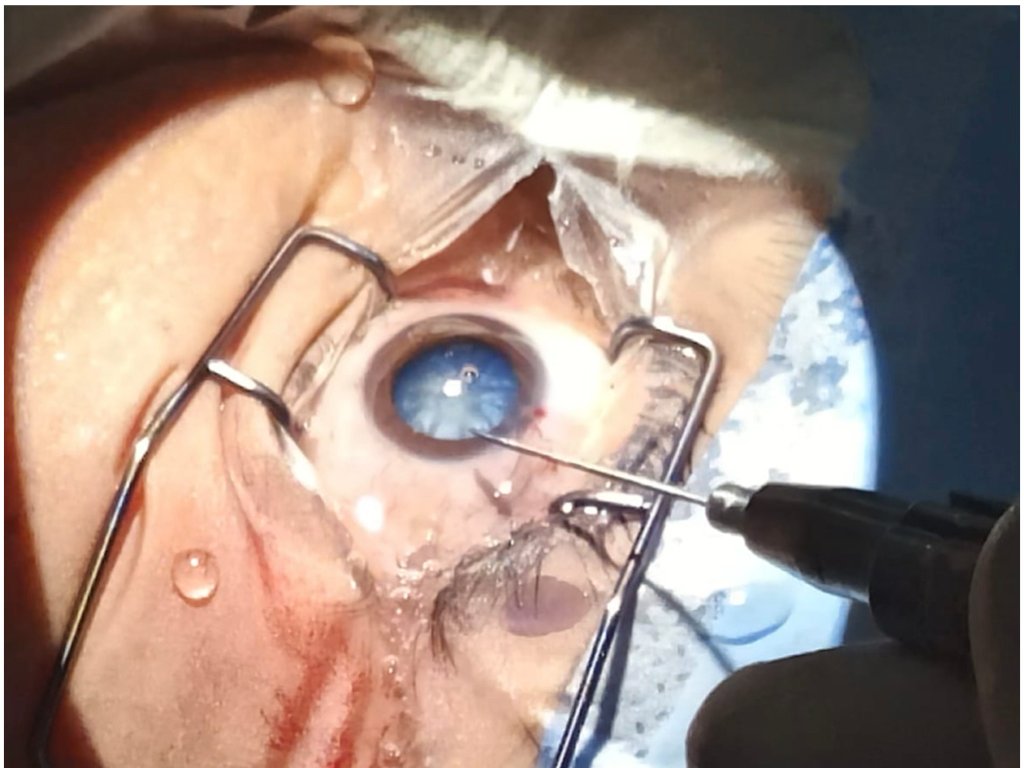 Best Time for Cataract Surgery